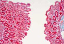 $6.5 million grant to help improve care for Crohn’s disease patients