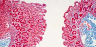 $6.5 million grant to help improve care for Crohn’s disease patients