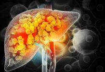Global study to spur new liver cirrhosis medicines