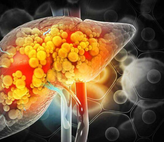 Global study to spur new liver cirrhosis medicines