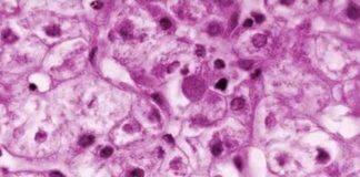 Study examines medical mystery of child hepatitis outbreak