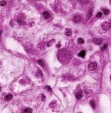 Study examines medical mystery of child hepatitis outbreak