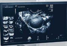 Breaking down the barriers for endometriosis care