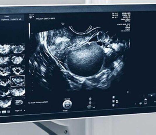 Breaking down the barriers for endometriosis care