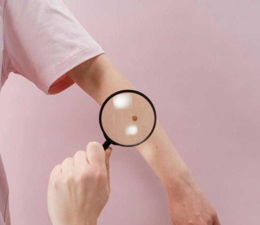 Giving doctors an AI-powered head start on skin cancer
