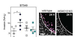 New study uncovers how beta blockers could halt the progression of triple negative breast cancer