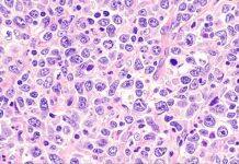 Breakthrough gives hope in fight against aggressive form of blood cancer