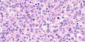 Breakthrough gives hope in fight against aggressive form of blood cancer