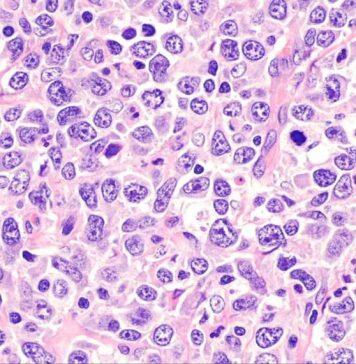 Breakthrough gives hope in fight against aggressive form of blood cancer